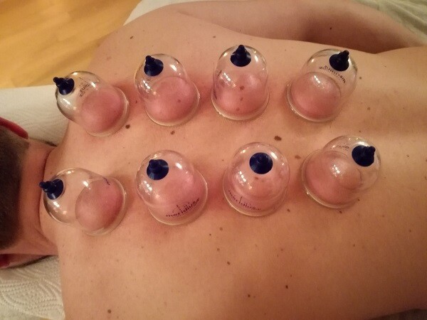 Franziska Nisslmüller von Massage Klosterneuburg beim Schröpfen